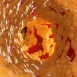 دهون خفية تلحق الضرر بالشرايين حتى لدى النحفاء