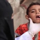 تسجيل 29 حالة إصابة بفيروس شلل الأطفال في اليمن